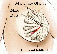 Blocked mammory ducts